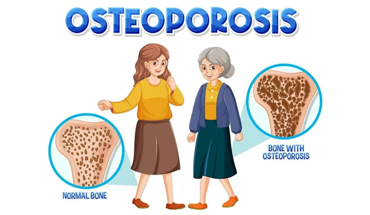 Terkena Osteoporosis Ini yang Harus Dilakukan