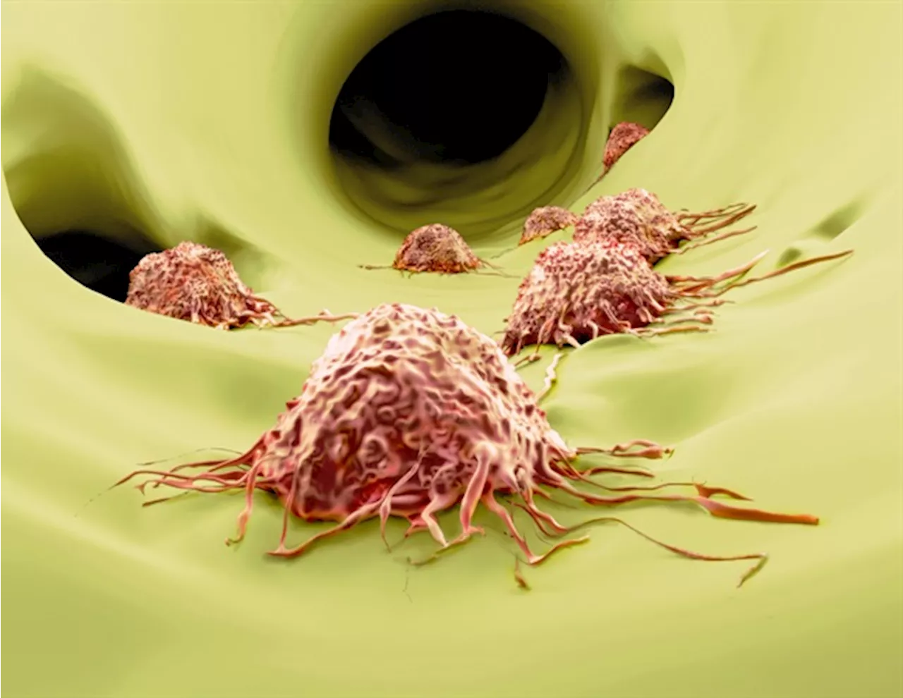 Immunotherapy yields complete response in stage IV lung cancer