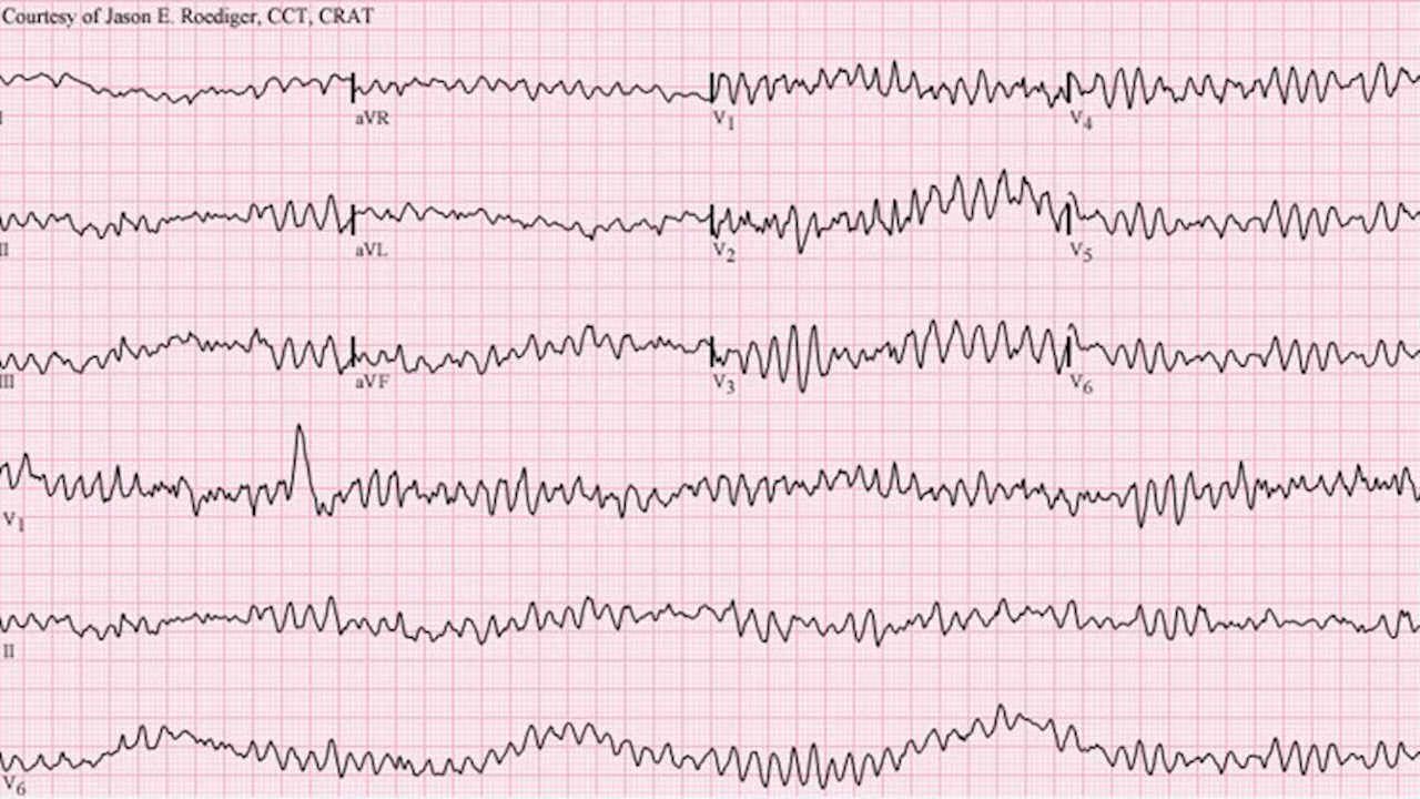 Cardiac Monitoring Is Crucial in Neuromuscular Disorder Care