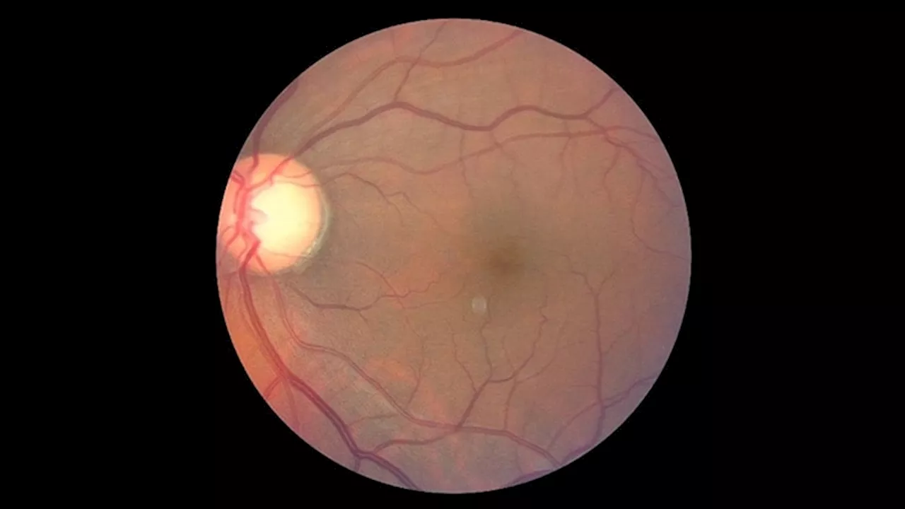 More Than 4 Million US Adults Had Glaucoma in 2022