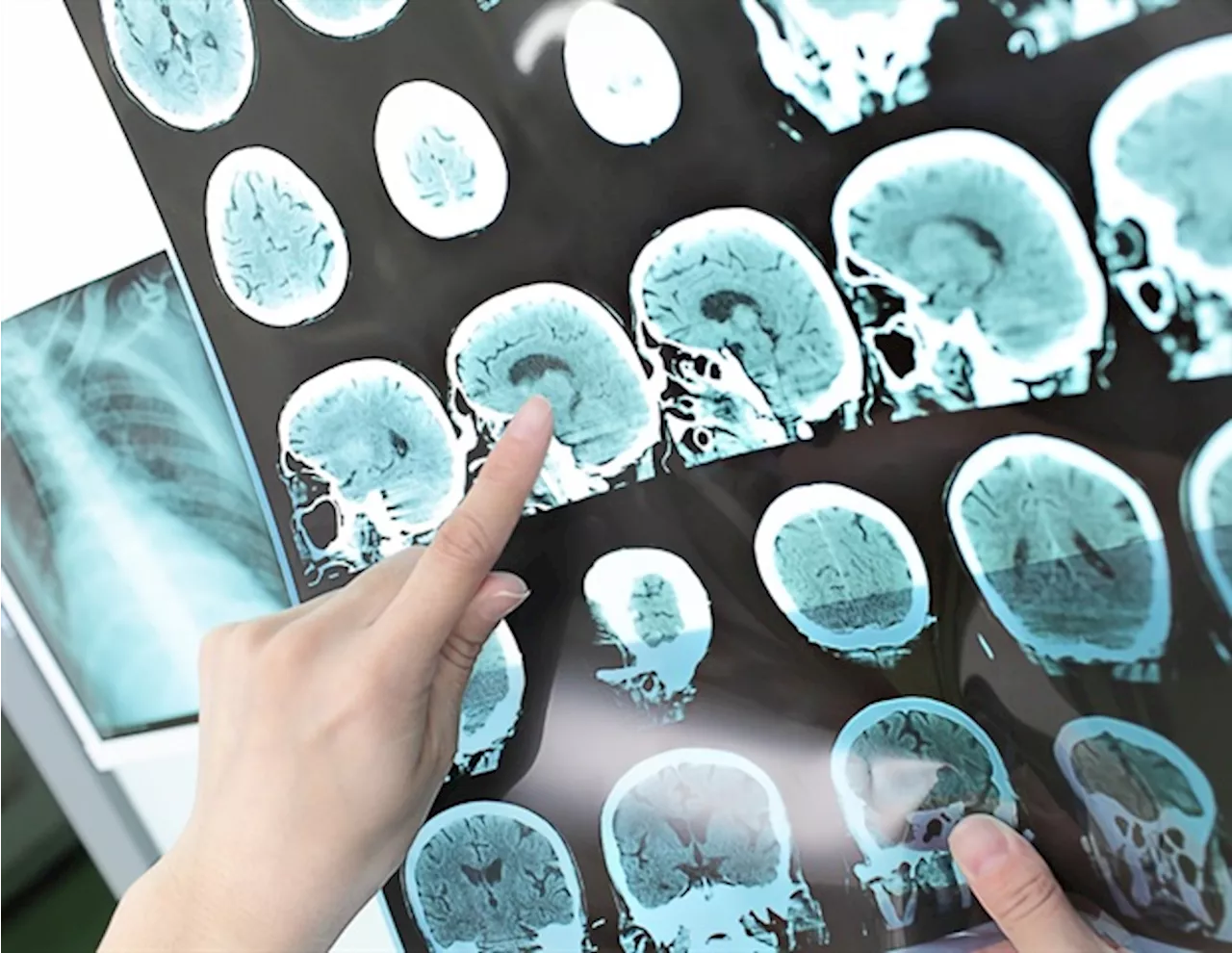 New prediction model helps identify epilepsy risk after stroke