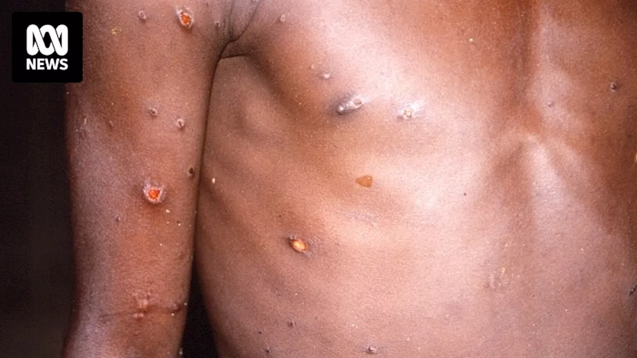 Germany identifies its first case of clade 1b mpox, becoming fifth country outside Africa linked to outbreak