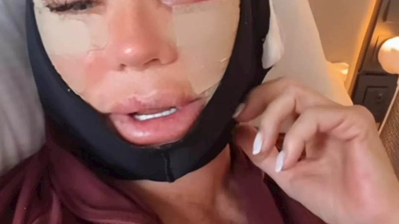 Real Housewives star Dawn Ward reveals shocking results of facelift on the 'worst day' of recovery...