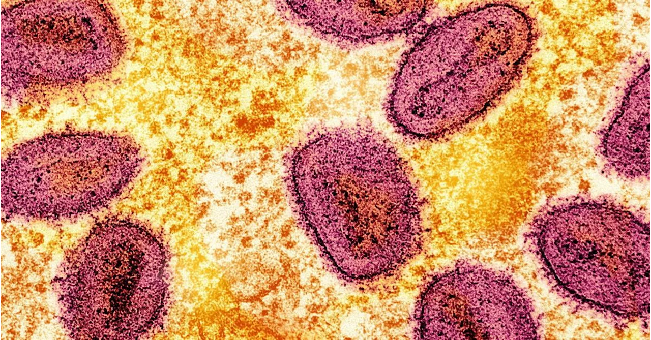 Mpox: Erster Fall mit neuer Variante in Deutschland