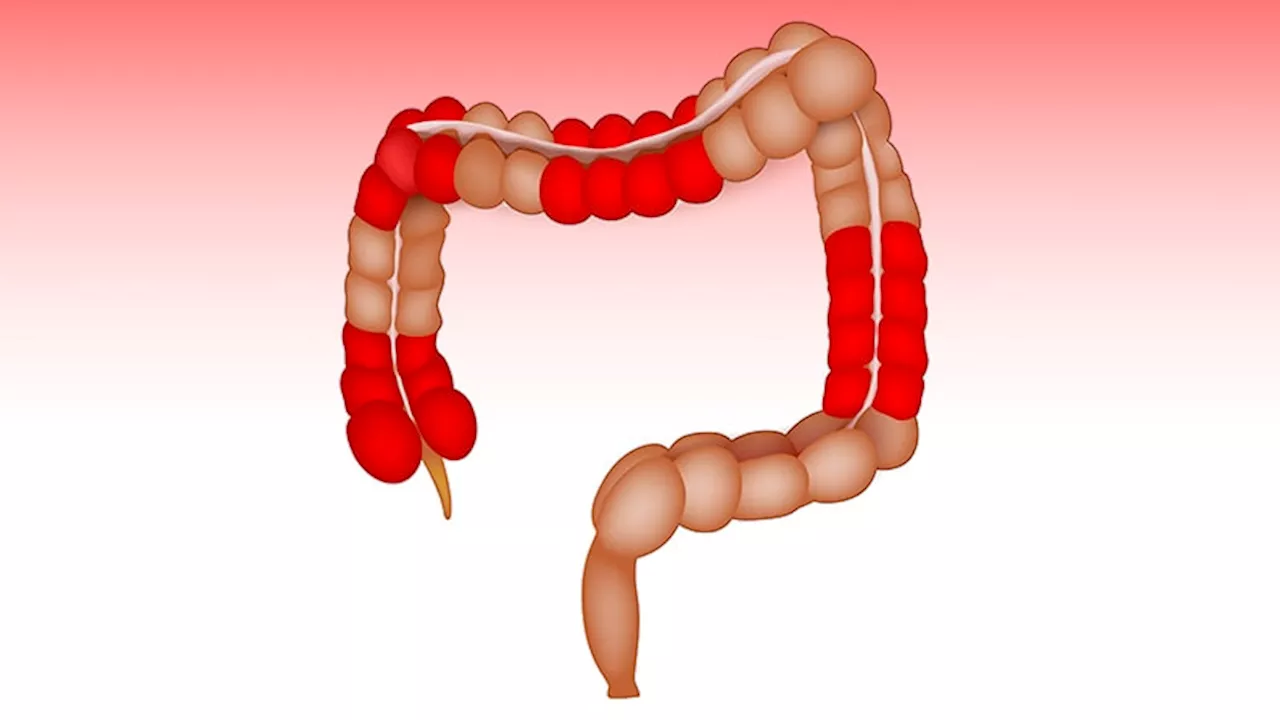 Guselkumab Efficacy in Crohn's Disease Unaffected by Prior Biologic Use