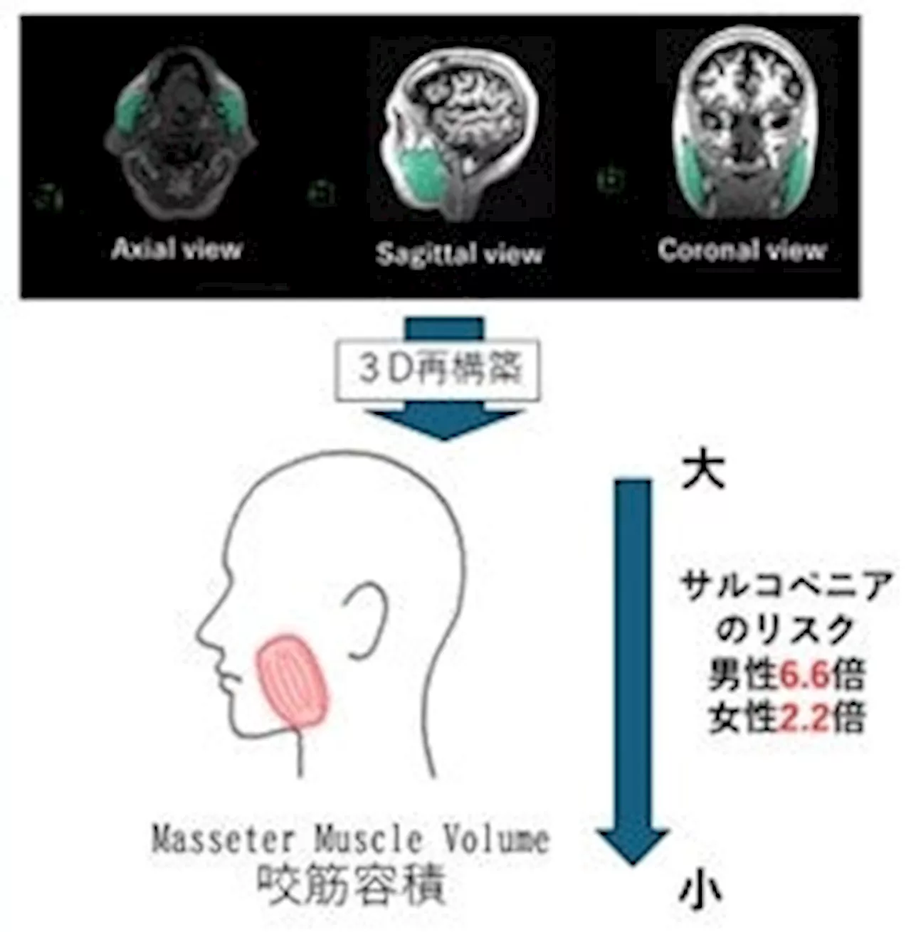 咬筋容積の低下がサルコペニアリスクを高める