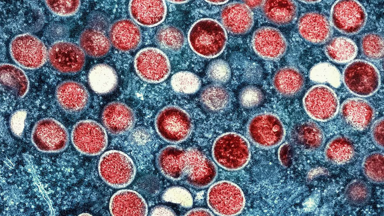 Mpox-Virus: Erstmals Variante Klade Ib bei uns in Deutschland nachgewiesen