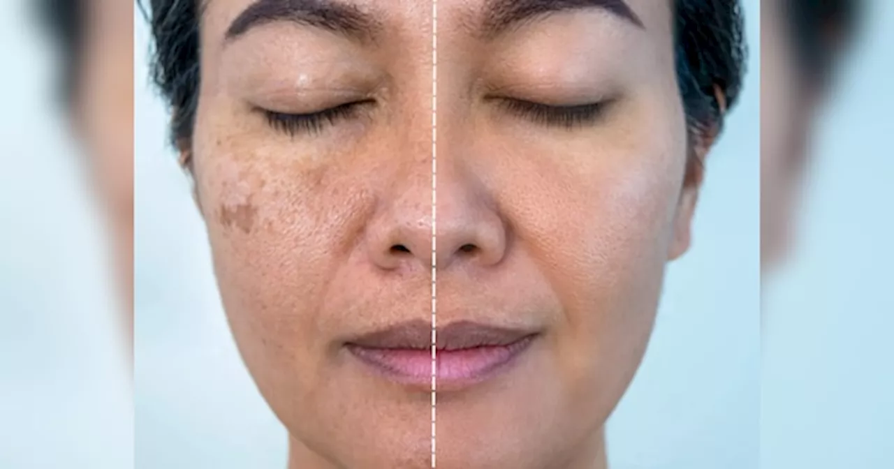 दिवाली से पहले साफ हो जाएगी चेहरे की झाइयां, आजमाएं Pigmentation से छुटकारा पाने के लिए ये उपाय