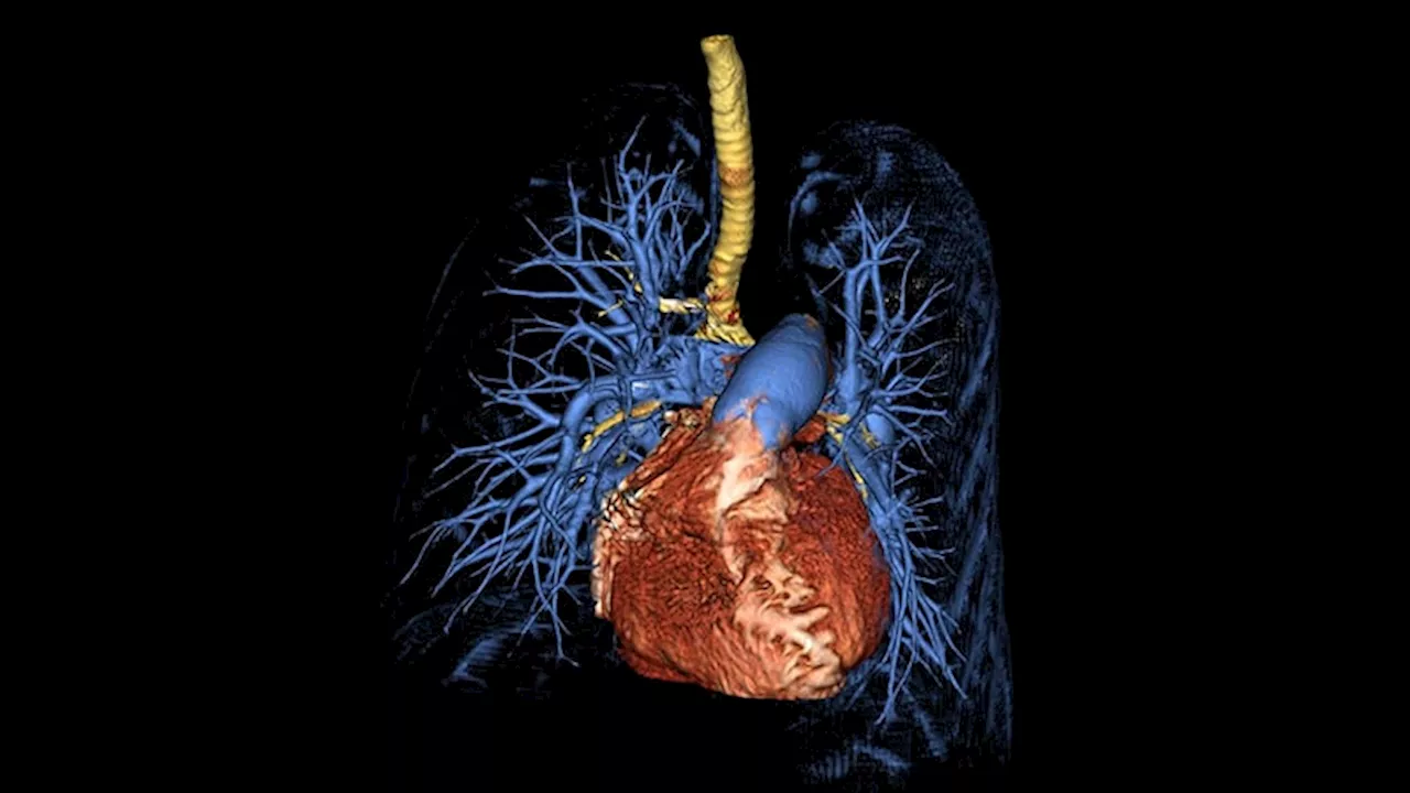 Social Adversity Tied to Poorer Mortality in Patients With Pulmonary Hypertension