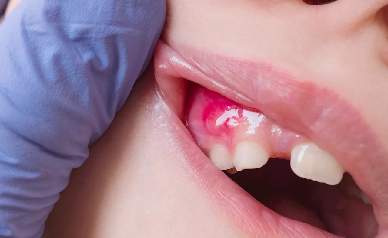 सूज गए हैं मसूड़े तो नमक में मिलाकर लगा लें यह एक चीज, Swollen Gums को मिल जाएगा आराम