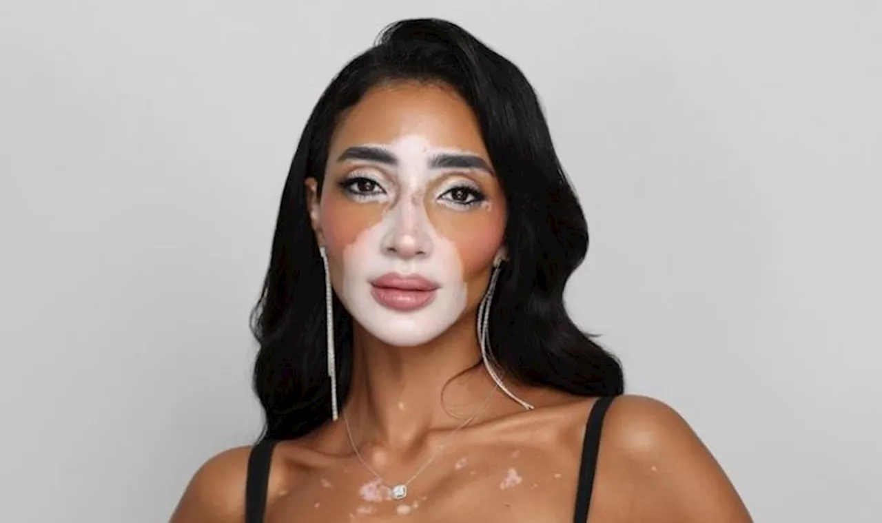 Conoce a Miss Egipto, Logina Salah, la primera aspirante a Miss Universo con vitiligo