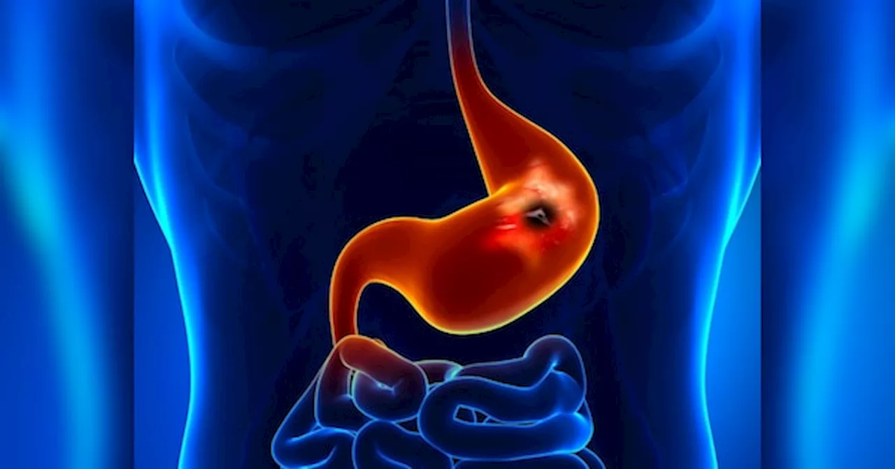 Stomach Ulcer: पेट में अल्सर का खतरा बढ़ाती हैं ये 5 गलतियां, आपकी सेहत हो सकती है को तबाह, तुरंत करें सुधार