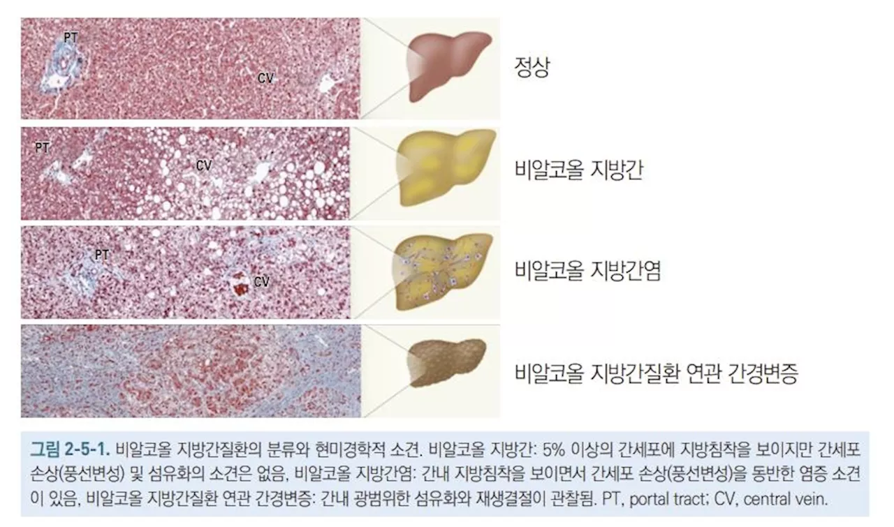 [위클리 건강] '술도 안 마시는데 지방간?…교대근무자에 발생 위험 높아'