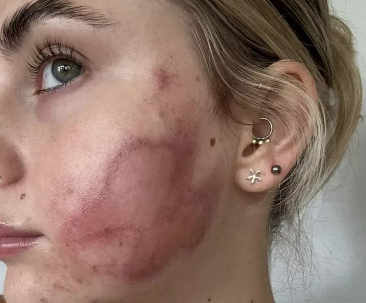 Mulher recorre a popular tratamento contra acne e acaba com queimaduras e cicatrizes permanentes