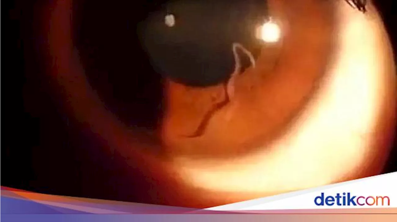 Cacing Gelang Sangat Berbahaya bagi Manusia, Ternyata Virus Ini Penyebabnya