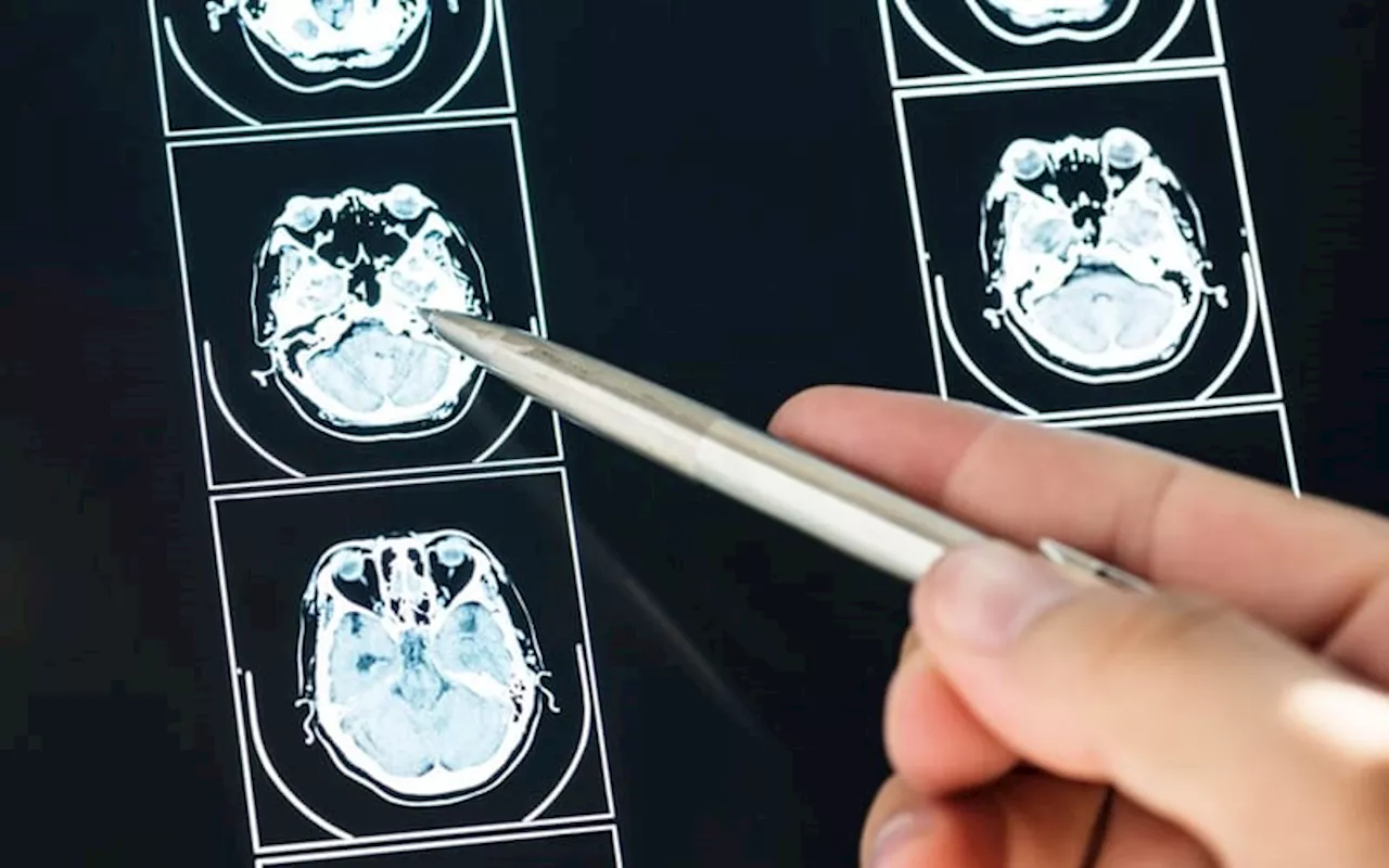 Hari Stroke Sedunia Meningkatkan Kesadaran Global untuk Pencegahan dan Penanganan Stroke