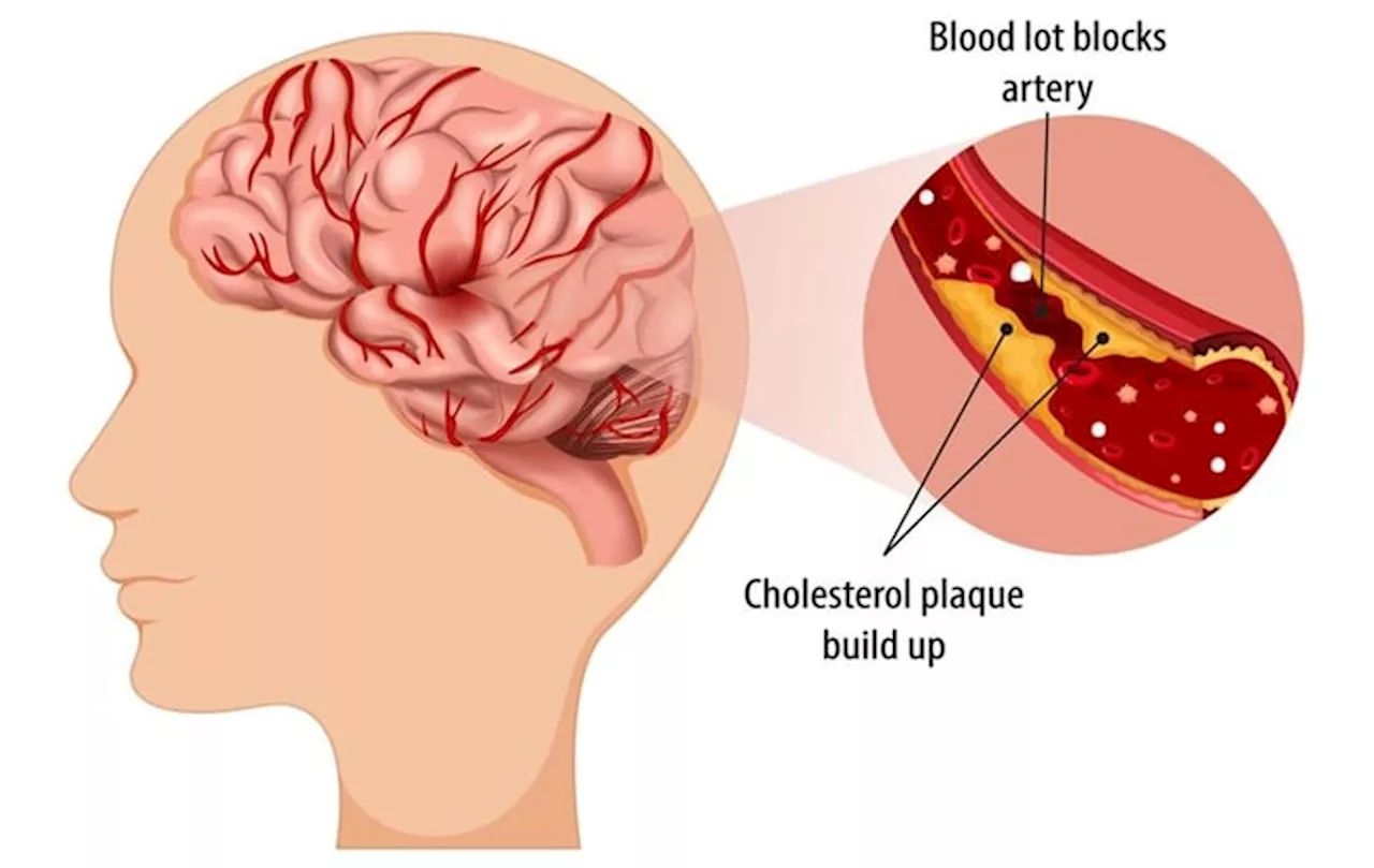 Mengenal Stroke Trombotik Penyebab, Gejala, dan Cara Pencegahan