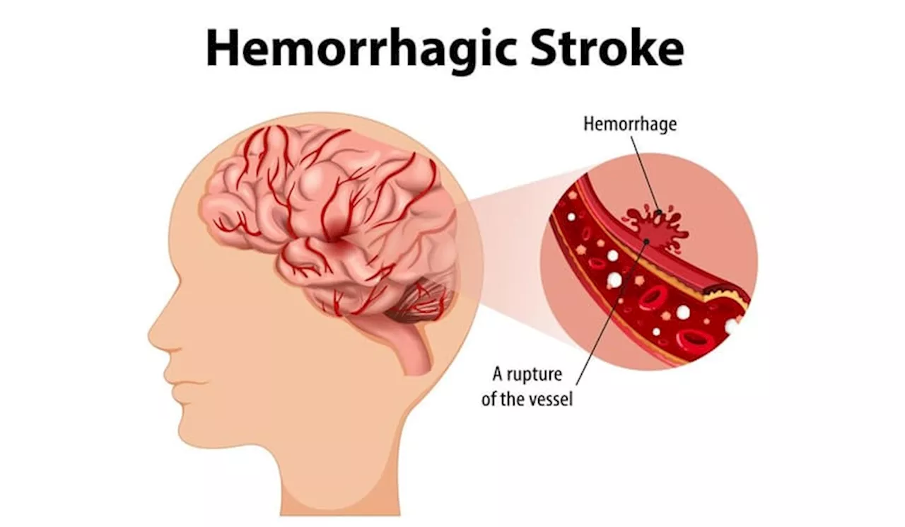 Stroke Hemoragik Gejala, Penyebab, dan Langkah Pencegahan