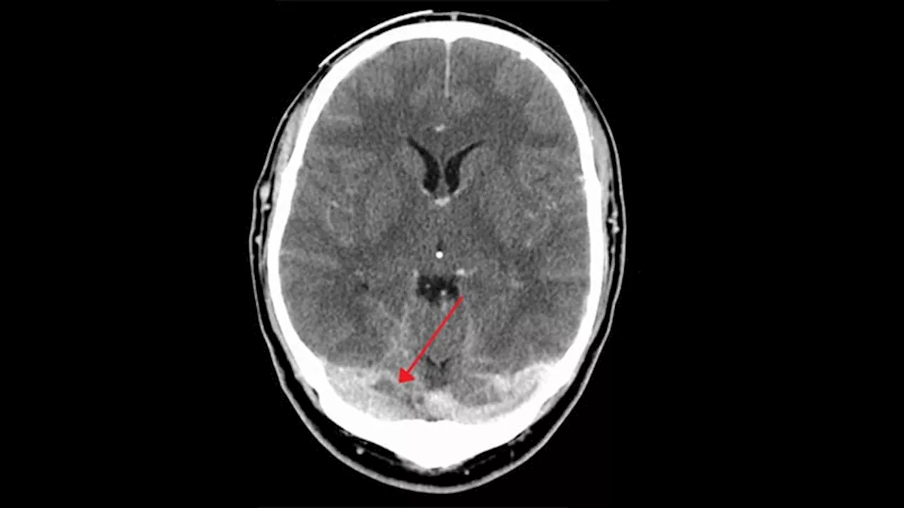 New Evidence Supports DOACs in Cerebral Venous Thrombosis