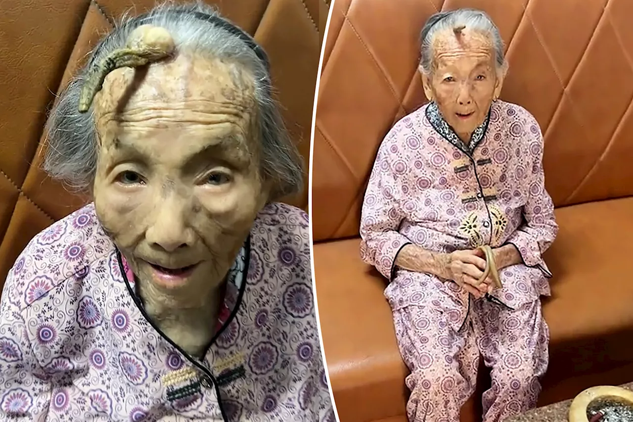 Woman lives to 107 despite 4-inch 'longevity horn' growing from her forehead