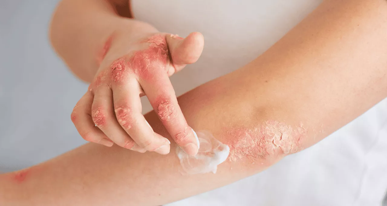 Picazón, dolor y piel enrojecida: síntomas de la dermatitis atópica