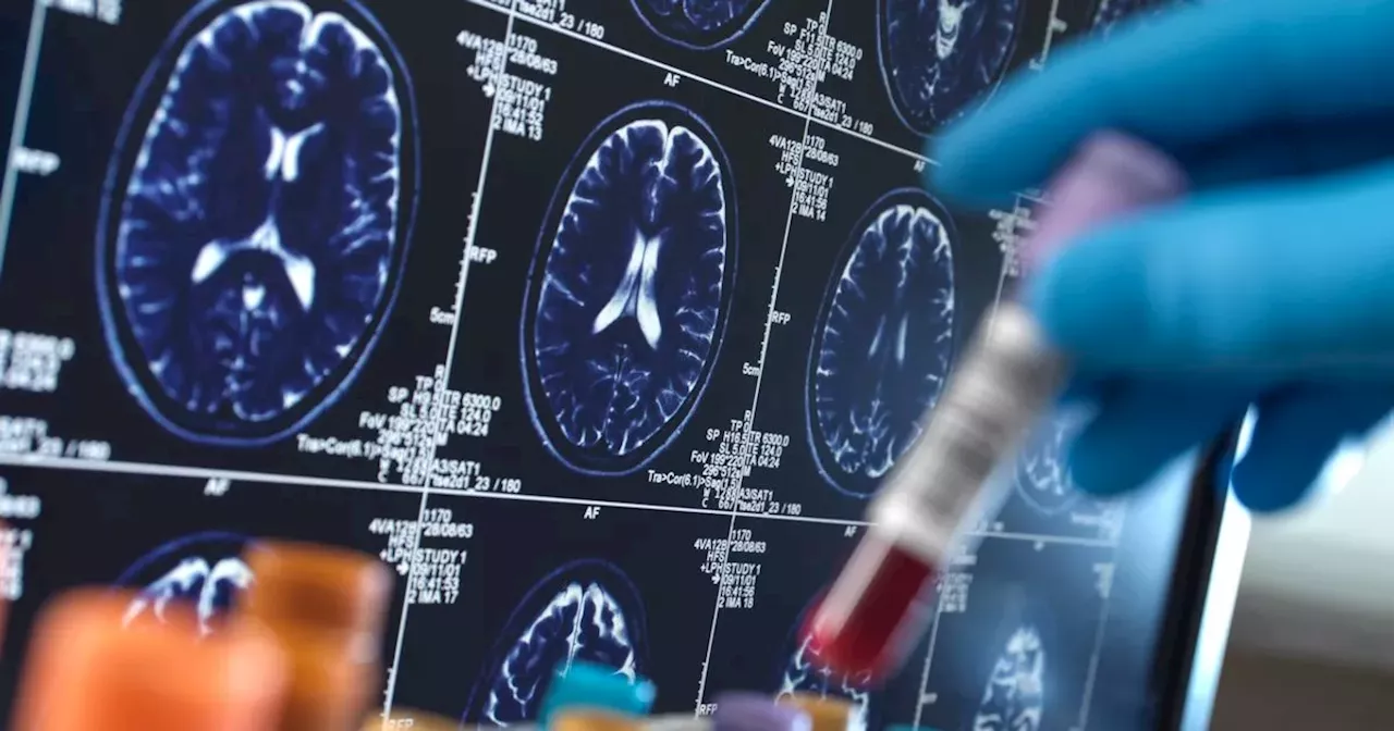 Researchers say new drug could stop Alzheimer's in its tracks