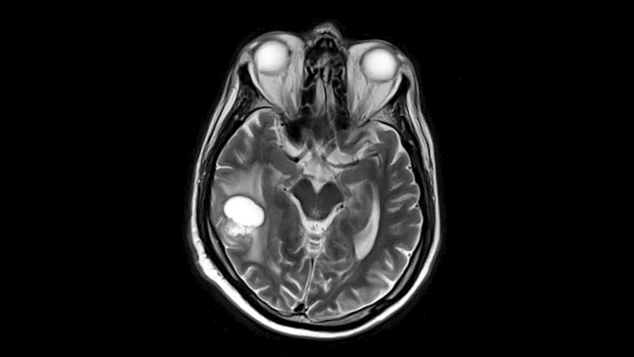 Full Cognitive Recovery After Brain Radiotherapy Possible for Many Patients