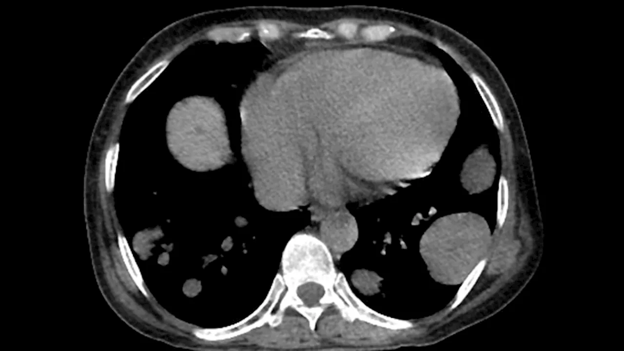 Trastuzumab Duocarmazine Ups PFS, Ocular Toxicity in Advanced HER2+ Breast Cancer