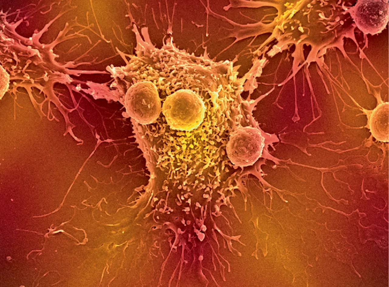 TCR cell therapies vanquish solid tumors — finally