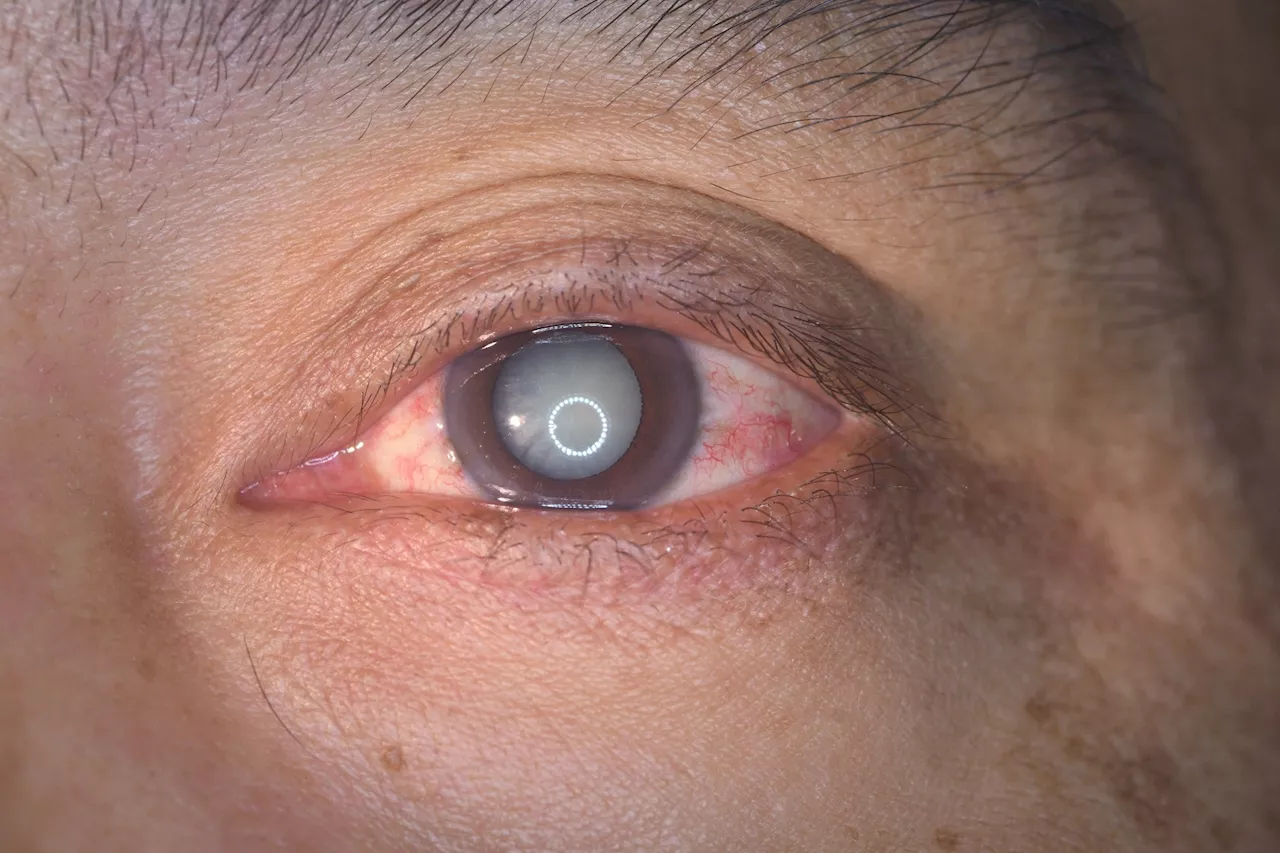 Researchers boost natural defenses to fight cataracts and delay the need for surgery