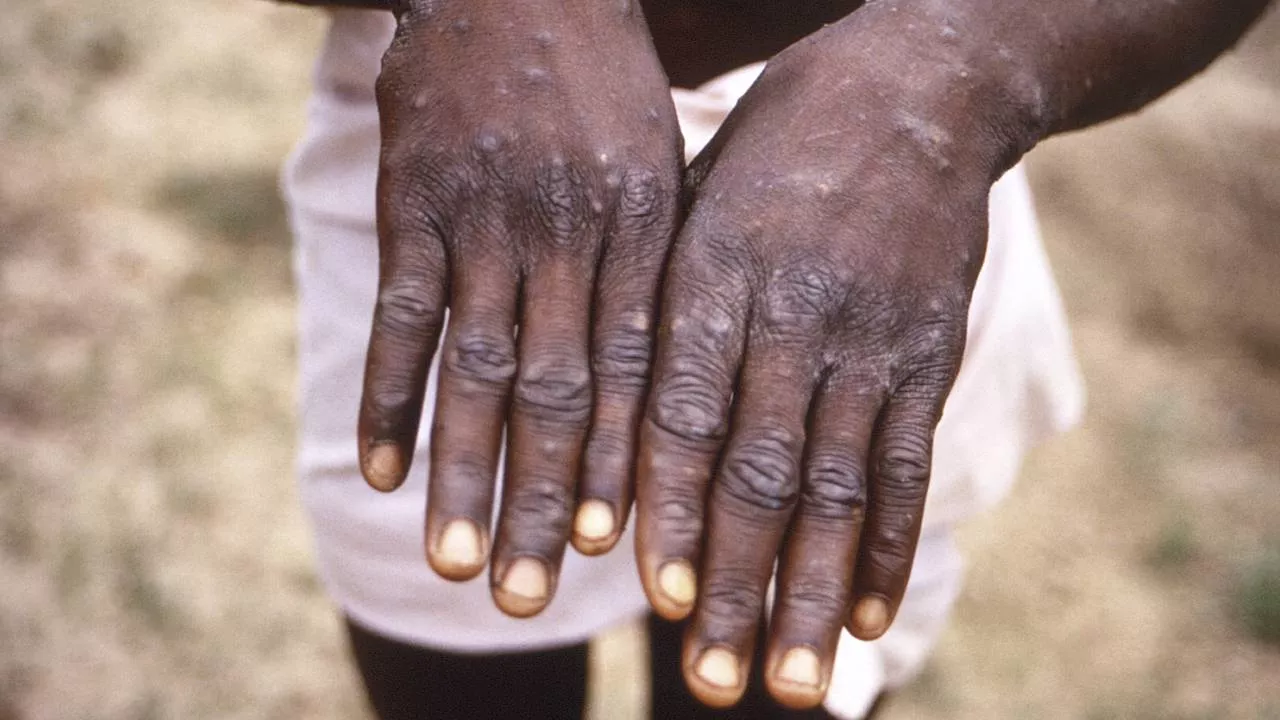 Mpox variant in Eindhoven is milde versie, vijf vragen en antwoorden