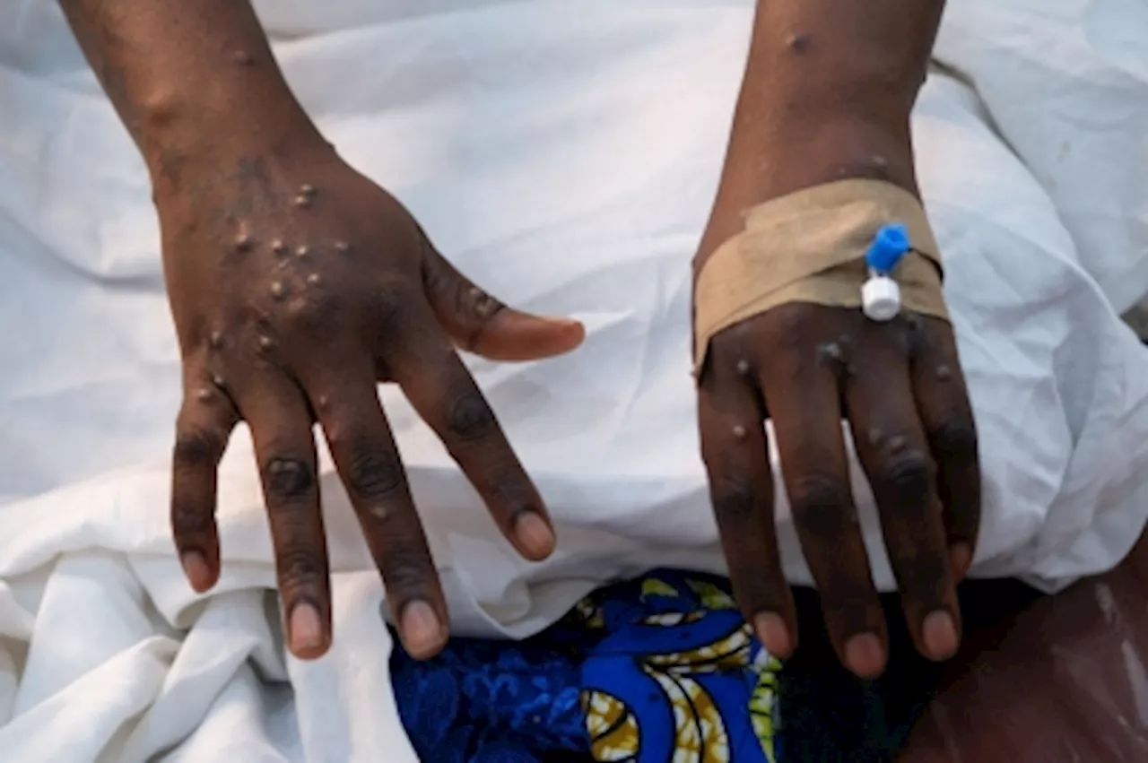 Months after declaring global health emergency, WHO approves first mpox diagnostic test