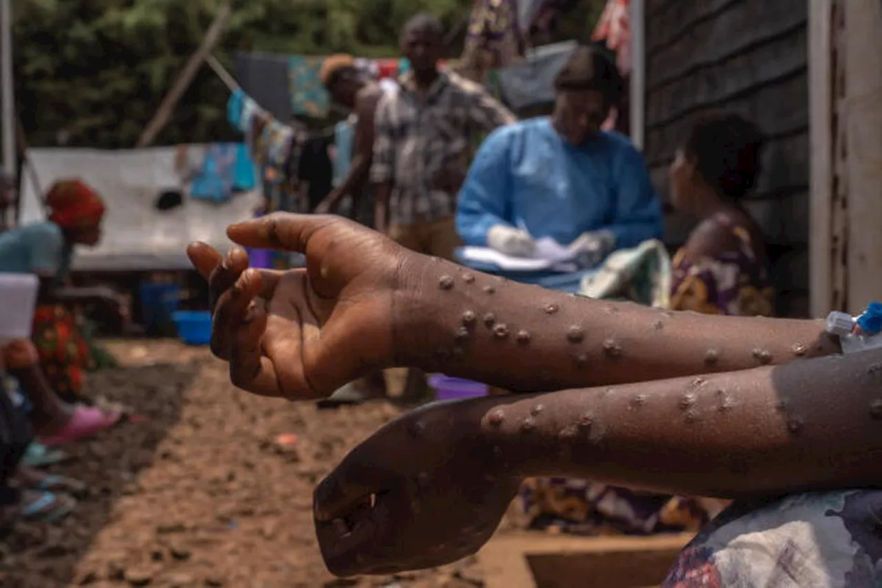 Mpox : lancement de la vaccination en République démocratique du Congo, épicentre de l’épidémie de variole