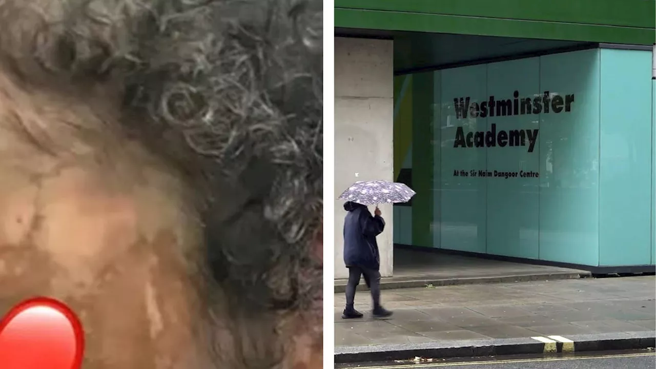 Man Bailed After Acid Attack at London School Leaves Girl Scarred for Life