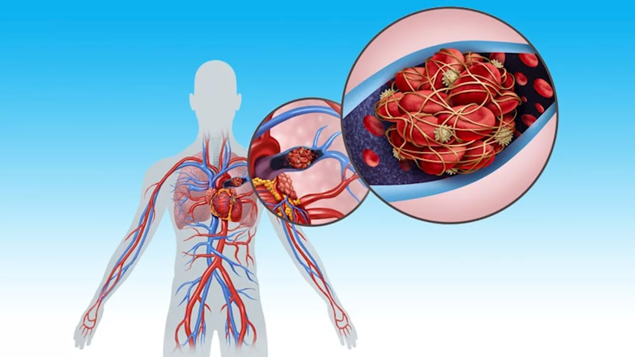 ILD Linked to Worse Outcomes in Pulmonary Embolism