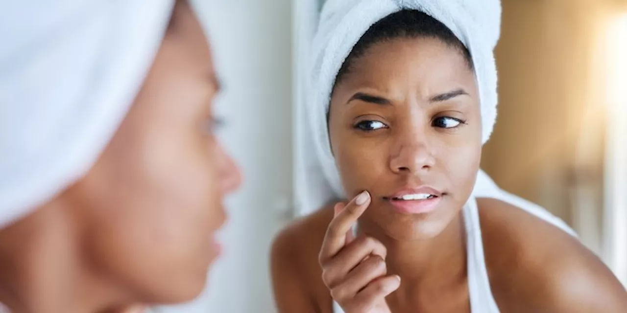 These Spots Are Often Confused For Hyperpigmentation (But Here's What They Really Are)