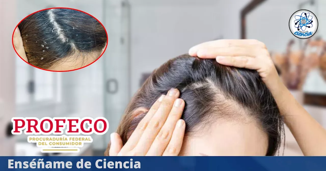 Eliminan la caspa: estas son las mejores marcas de shampoo que combaten la caspa, según PROFECO