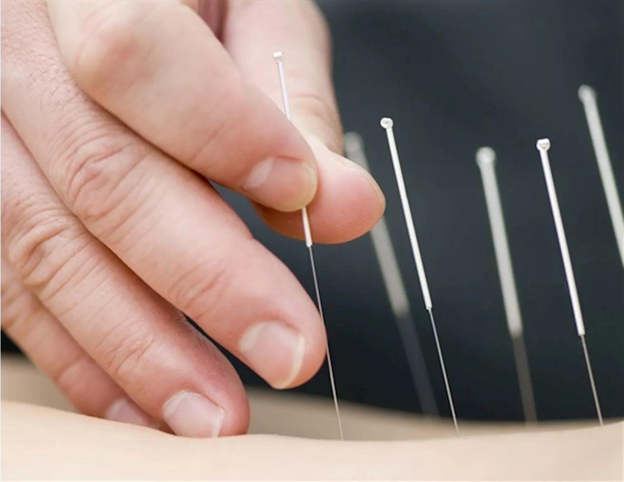 Electro-acupuncture shows promise in obesity management