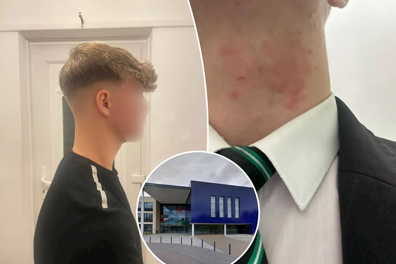 School Gives Teen Detention For 'Fade' Haircut To Help With Eczema