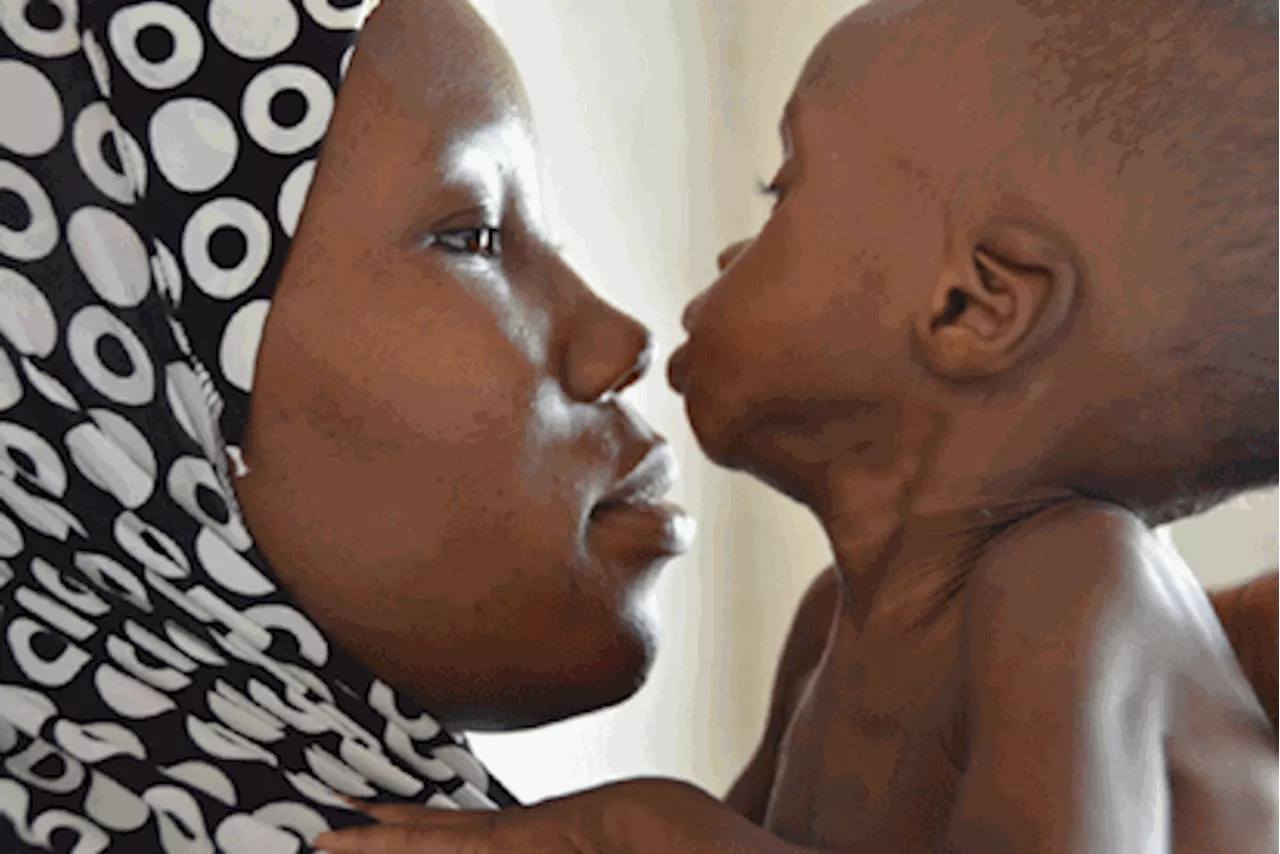 Malnutrition: FG, CAN, W/Bank unite to save 11m Nigerian children