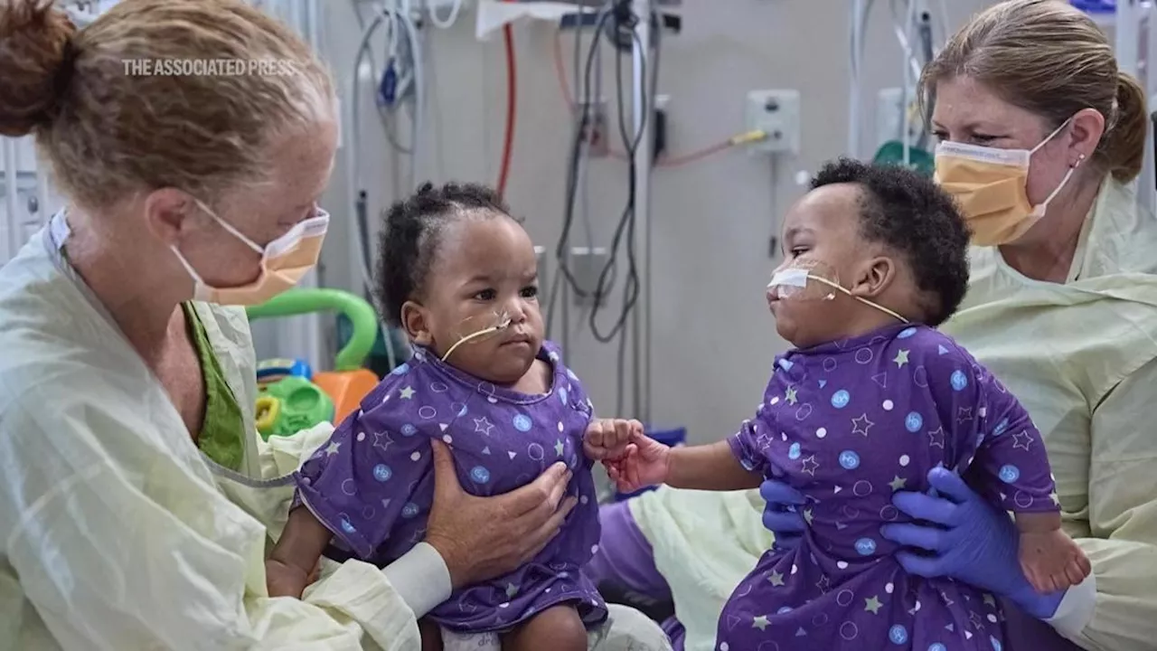 Children’s Hospital of Philadelphia successfully separates conjoined twin boys