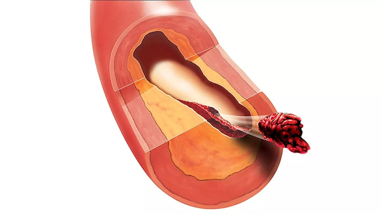 Thrombectomy Tops Thrombolysis in Pulmonary Embolism Trial