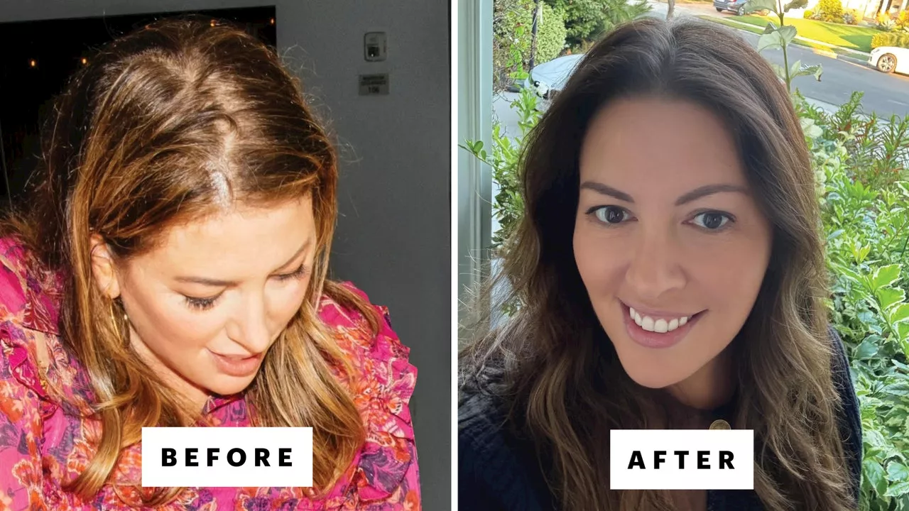 I Tried Everything to Treat My Hair Loss