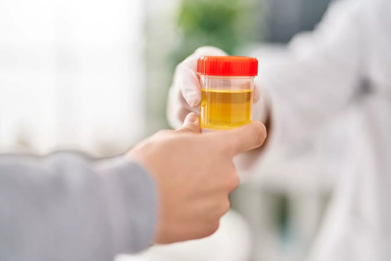 Innovative urine test could improve pancreatic cancer survival rates