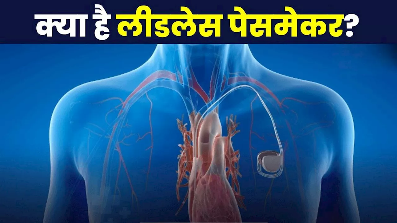 Leadless Pacemaker: क्या है लीडलेस पेसमेकर, जिसका भारत में पहली बार हुआ यूज, जानिए कितनी होती है कीमत