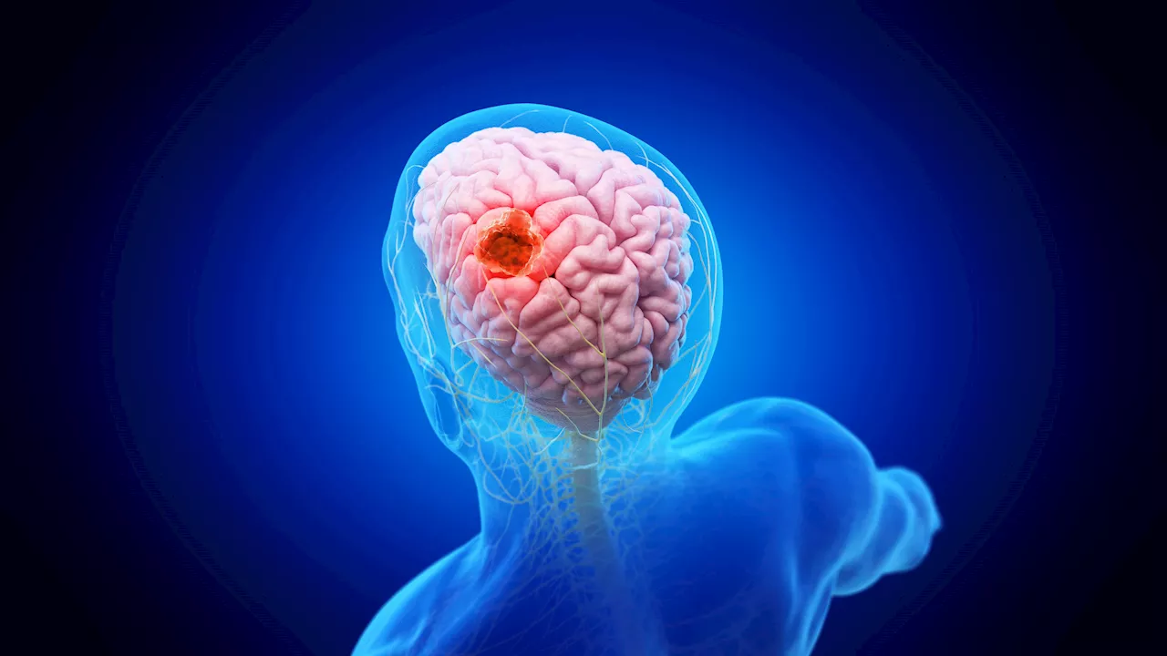 Nueva terapia muestra avances en la supervivencia de pacientes con cáncer cerebral de baja supervivencia