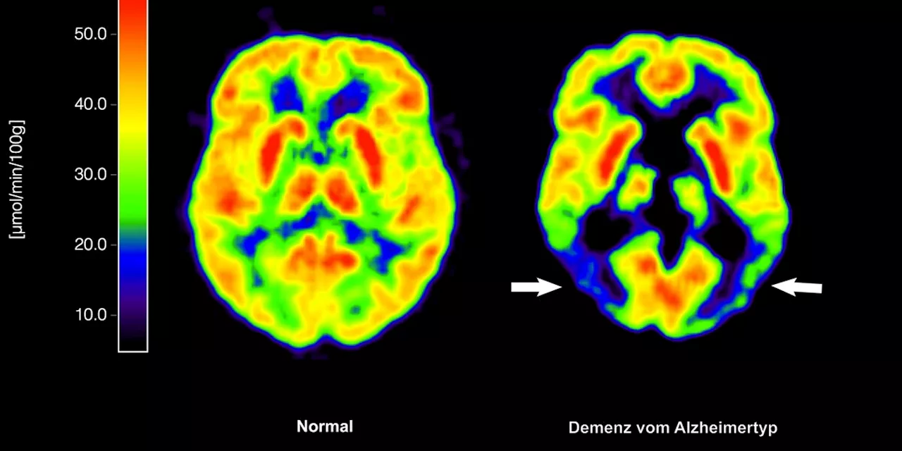 Gesundheit: Antikörper Lecanemab: Wie er wirkt und wem er helfen kann