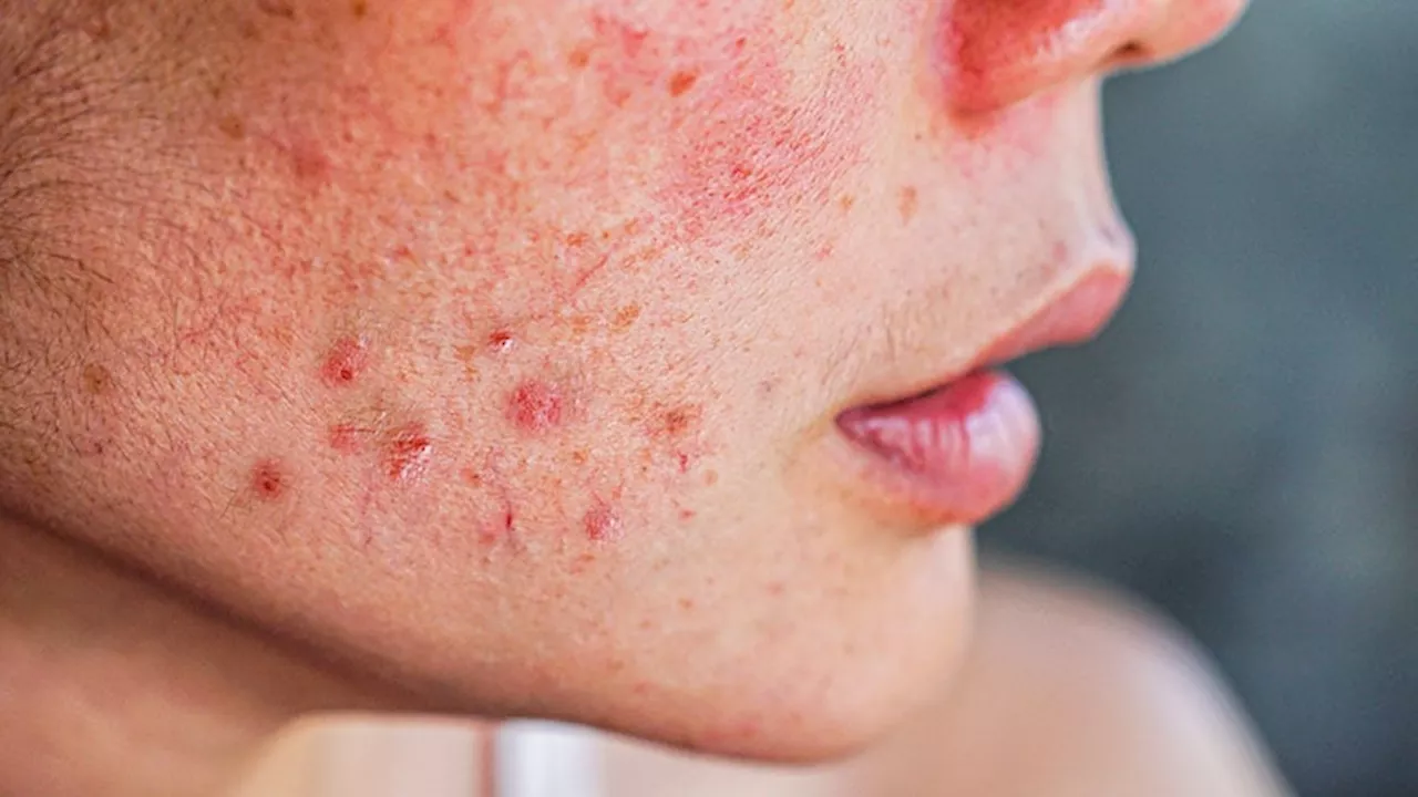 Why Topical Retinoids Are a Key Component of Every Acne Regimen