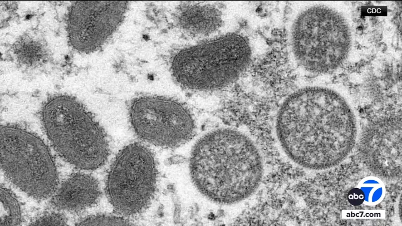 United States' first known case of more severe strain of mpox is confirmed in Northern California