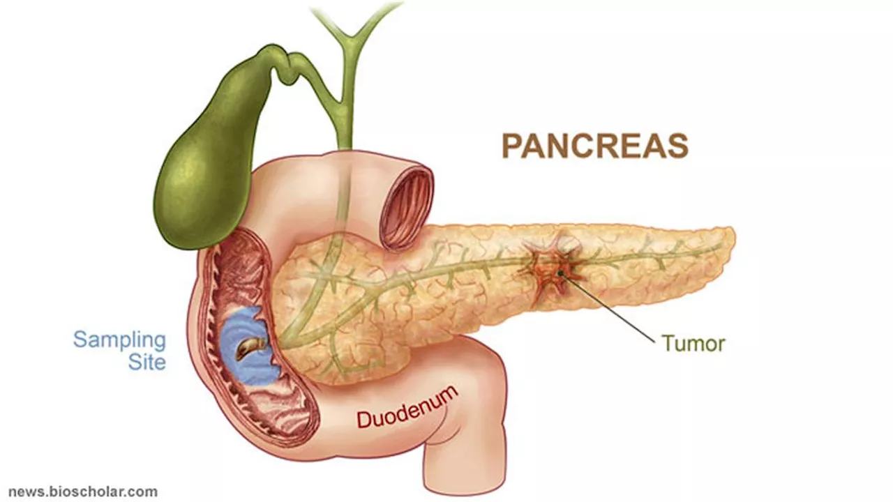 Hari Kanker Pankreas Sedunia, Ketahui Penyebab dan Gejalanya